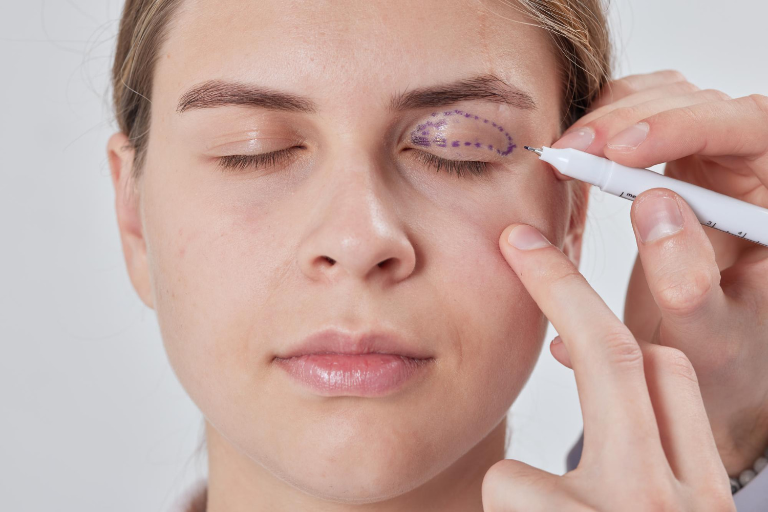 Oculoplastic examination for eyelid surgery at Centro Oftalmológico del Llano